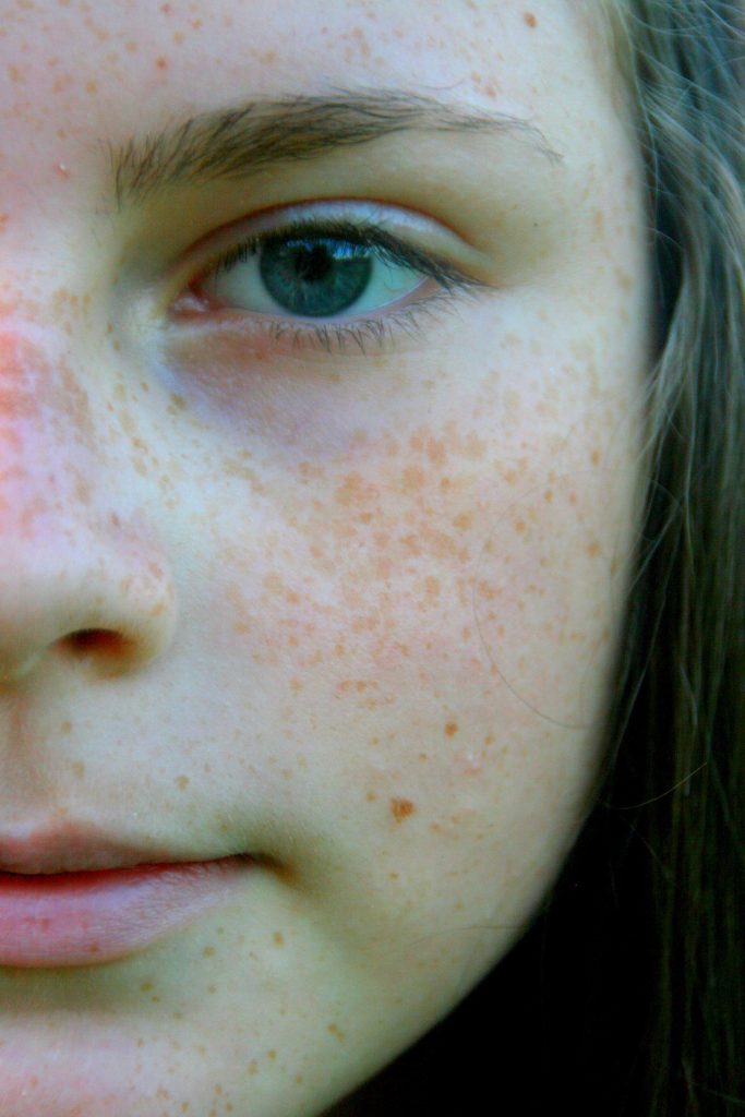 Hyperpigmentation: Darkening of the Skin