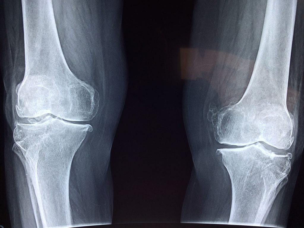 Bone Health Considerations: Balancing Act