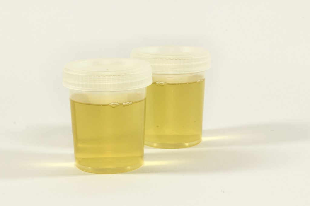 Dark Yellow Urine: A Window to Hydration Status