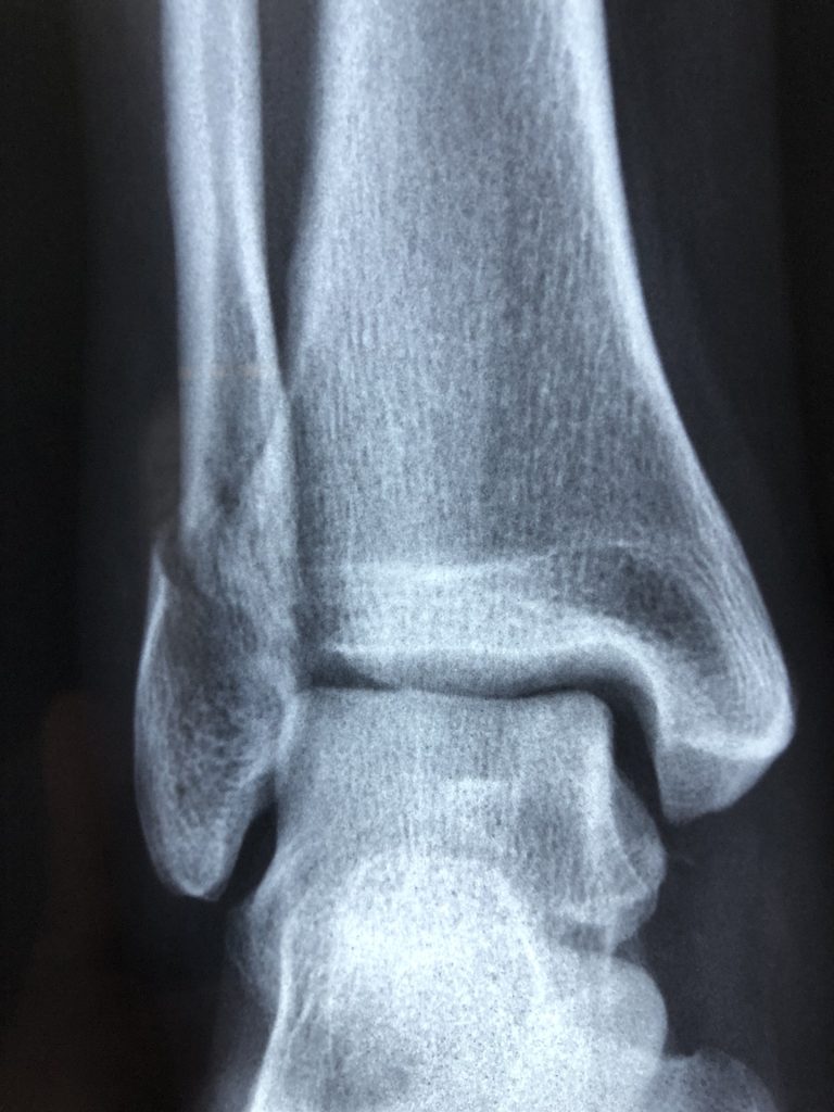 Bone Health and Dental Care